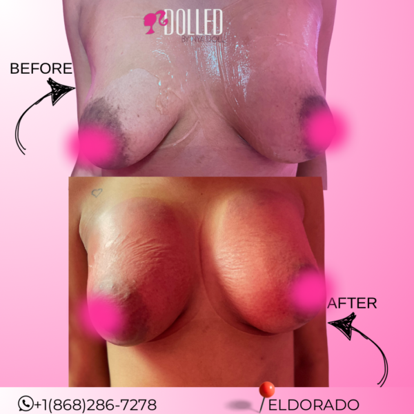 Vacuum Breasts Lift