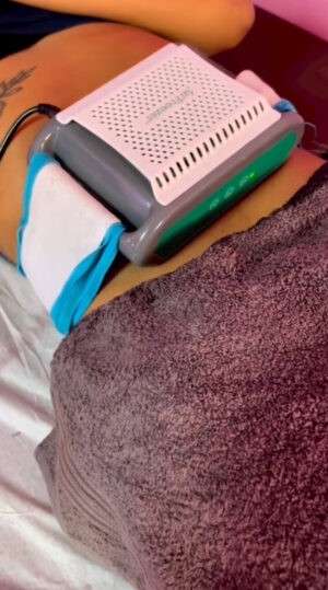 Fat Freezing Session