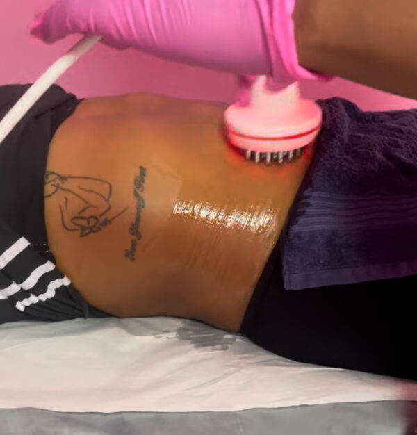 Skin Tightening Session