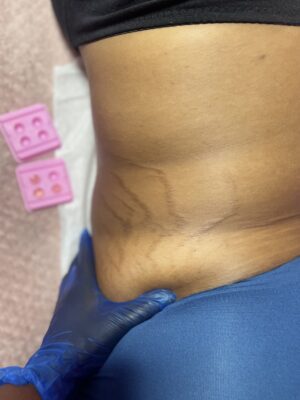 Inkless Stretch Mark Removal