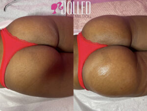 All natural butt lift and hip dip correction