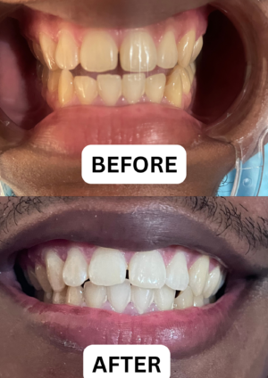 Dolled Cosmetic Teeth Bleaching