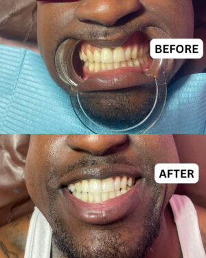 Dolled Cosmetic Teeth Bleaching